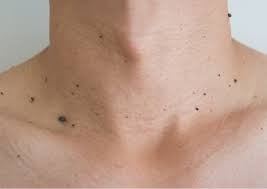 Mole Removal Myths and Facts