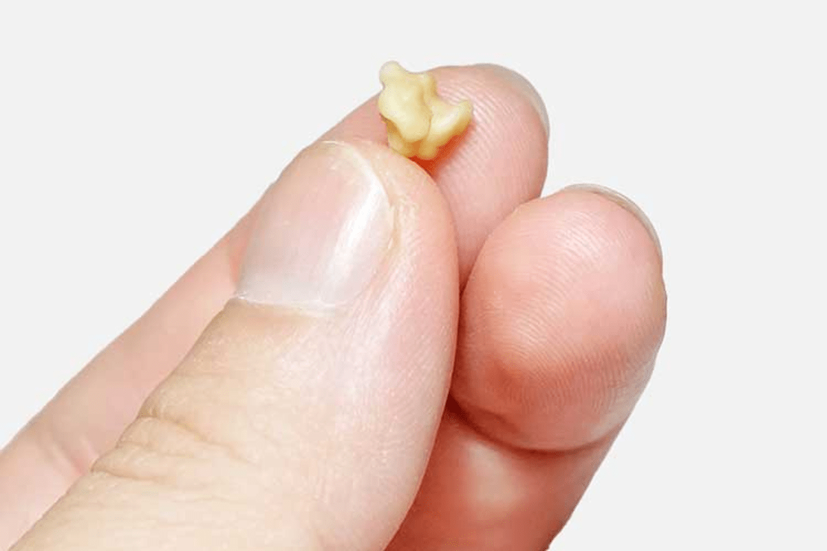 What Living With Throat Discomfort Taught Me About Tonsil stone removal Healthpally